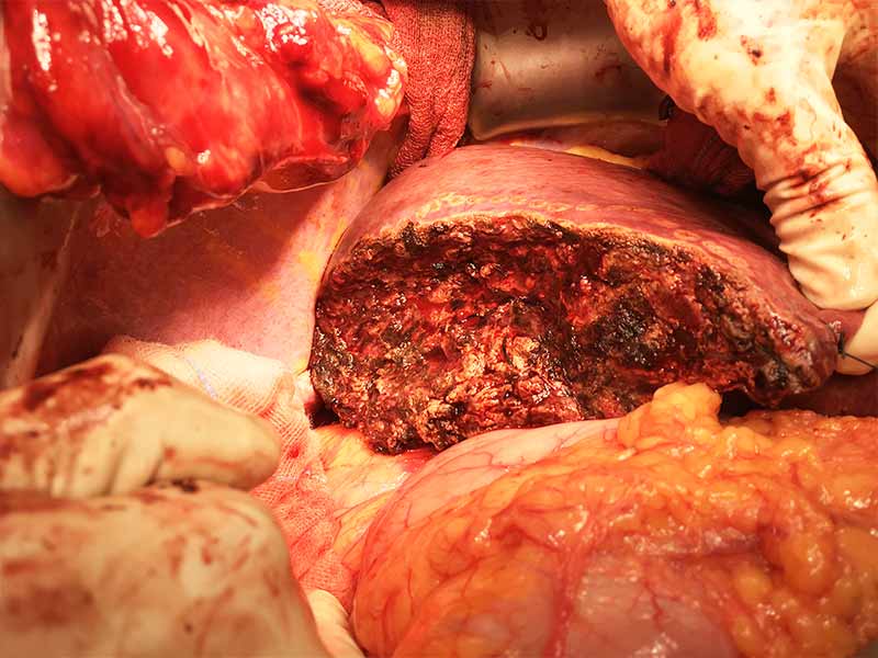 Bisegmentectomy for liver tumor