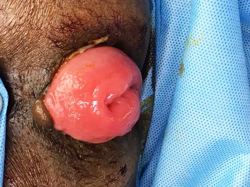 Delorme repair for complete rectal prolapse