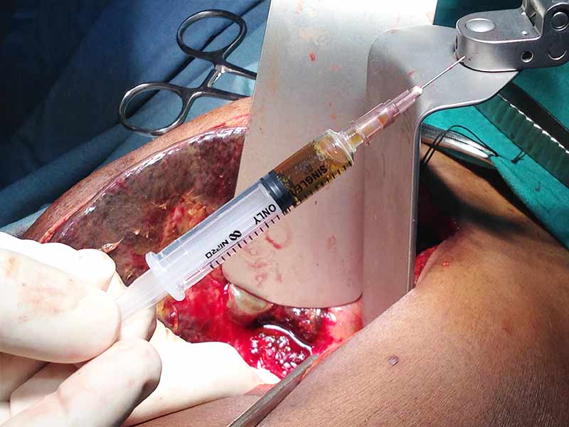 Distal pancreatectomy with splenectomy for hemosuccus pancreaticus for active bleeding pseudo aneurysm