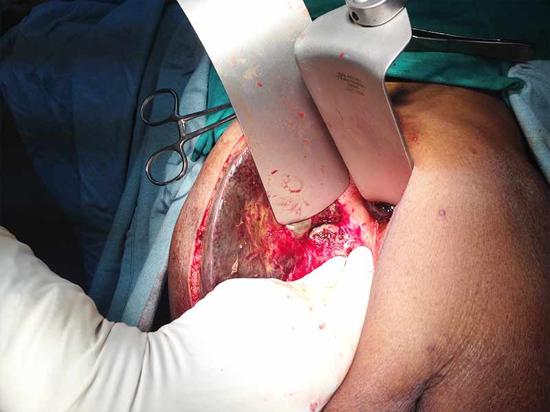 Distal pancreatectomy with splenectomy for hemosuccus pancreaticus for active bleeding pseudo aneurysm