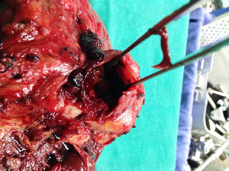 Distal pancreatectomy with splenectomy for hemosuccus pancreaticus for active bleeding pseudo aneurysm