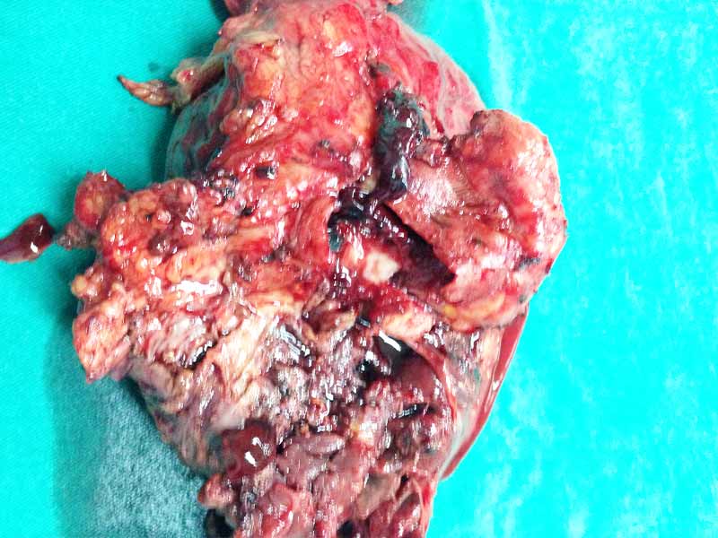Distal pancreatectomy with splenectomy for hemosuccus pancreaticus for active bleeding pseudo aneurysm