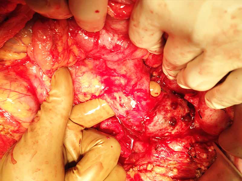 Distal pancreatectomy with splenectomy for hemosuccus pancreaticus for active bleeding pseudo aneurysm