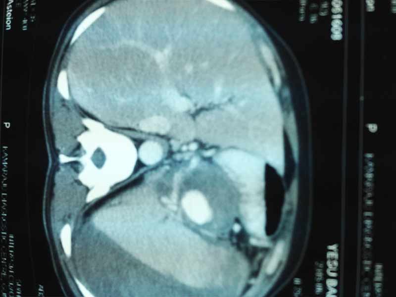 Distal pancreatectomy with splenectomy for hemosuccus pancreaticus for active bleeding pseudo aneurysm
