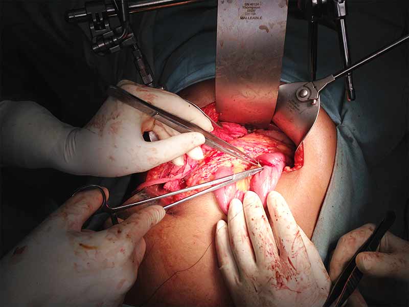 Early Hepaticojejunostomy for bile duct injury during laparoscopic cholecystectomy