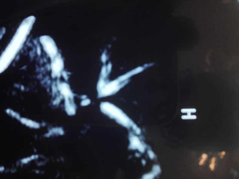 Early Hepaticojejunostomy for bile duct injury during laparoscopic cholecystectomy