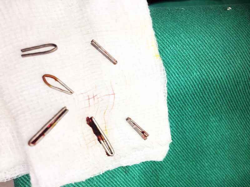 Early Hepaticojejunostomy for bile duct injury during laparoscopic cholecystectomy