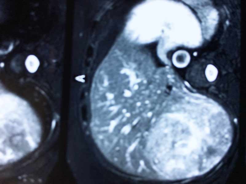 Bisegmentectomy for liver tumor