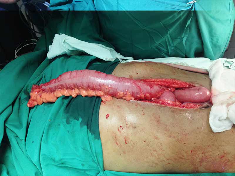 Colon transposition for stricture esophagus due to corrosive ingestion