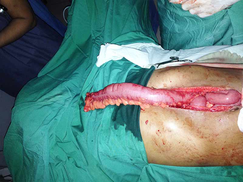 Colon transposition for stricture esophagus due to corrosive ingestion