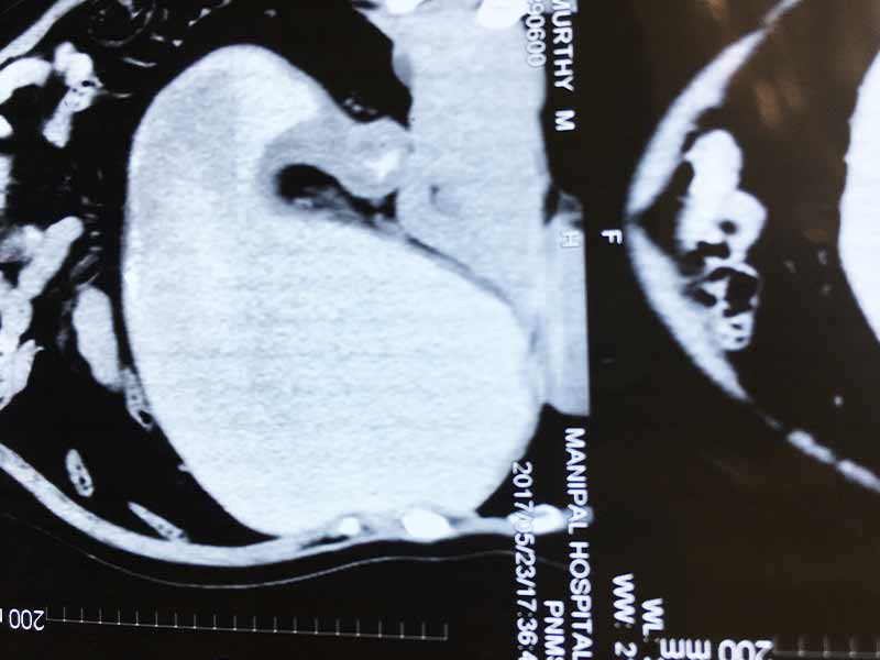 D2 gastrectomy for stomach cancer