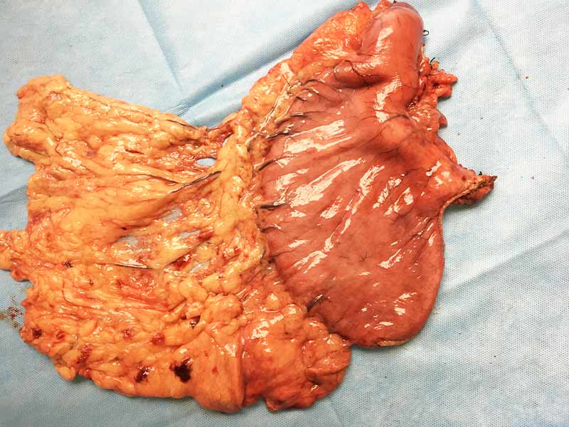 D2 gastrectomy for stomach cancer