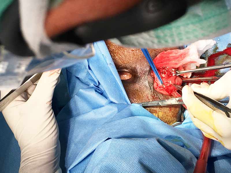 Delorme repair for complete rectal prolapse